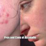 Pros and Cons of Accutane