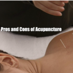 The Pros and Cons of Acupuncture